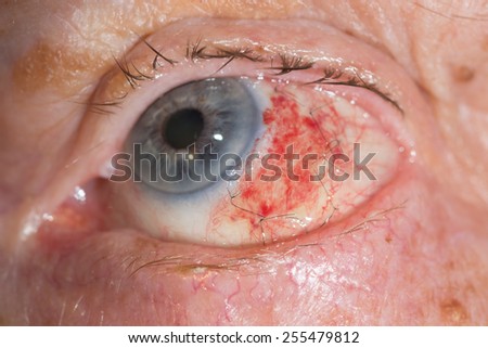 close up of the conjunctival stiches during eye examination.