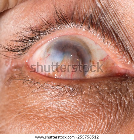 close up of the advance pterygium during eye examination.