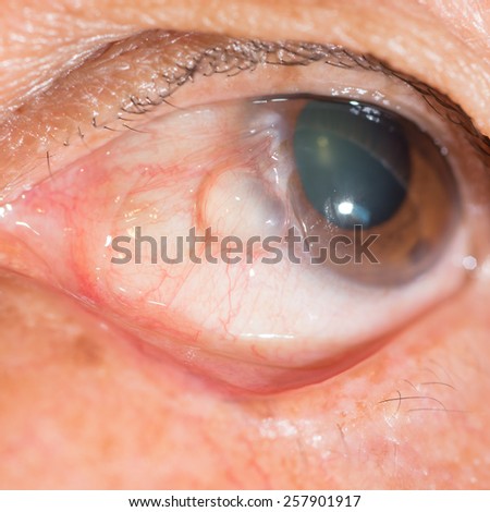close up of the conjunctival cyst during eye examination.