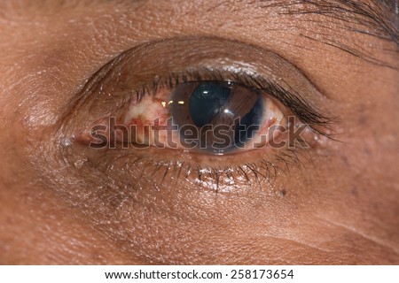 close up of the traumatic cyclodialysis during eye examination.