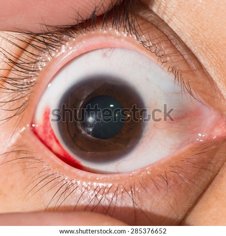 Close up of the sub conjunctival heamorrhage during eye examination.