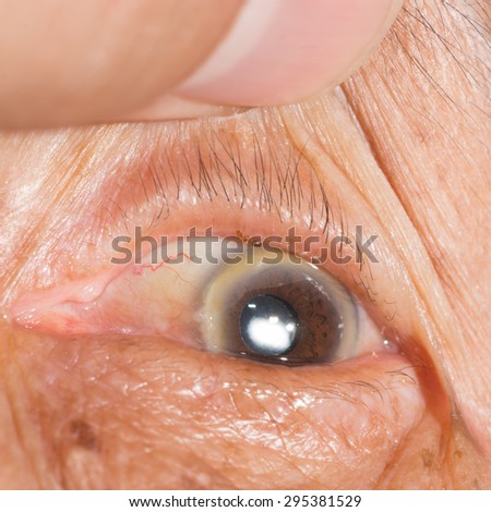 Close up of the small ant bite at eyelid margin during eye examination.