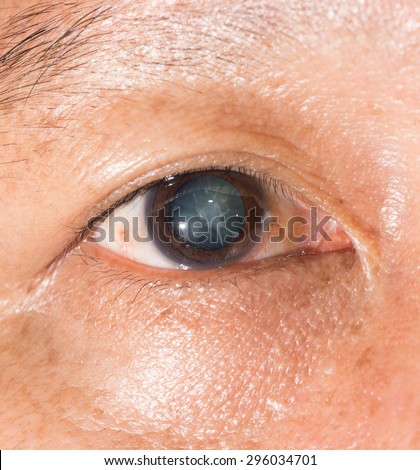 Close up of the cortical cataract during eye examination.