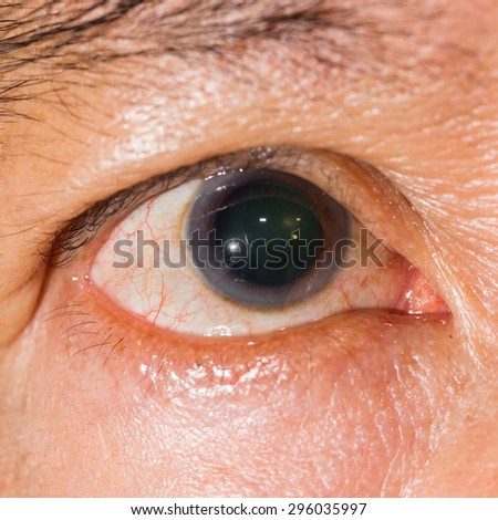 Close up of the dilated pupil eye during eye examination.
