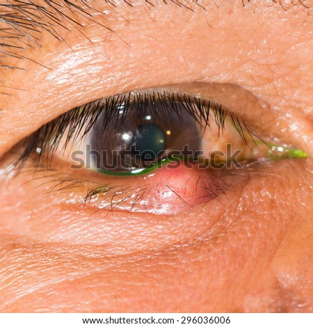 Close up of the stye during eye examination.