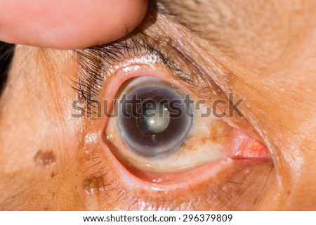 Close up of the cataract during eye examination.