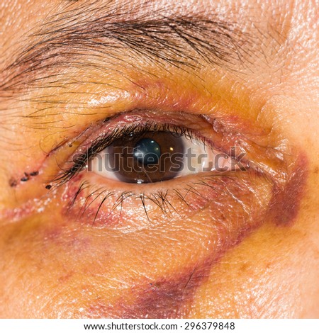 Close up of the post blepharoplasty during eye examination.