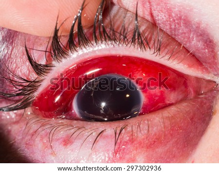 close up of the eight ball from blunt injury during eye examination.