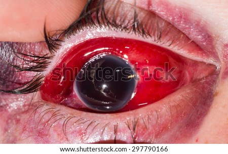 close up of the eight ball from blunt injury during eye examination.
