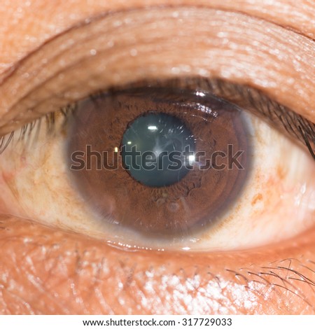 close up of the anterior sutural cataract during eye examination.