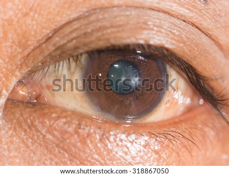 close up of the anterior sutural cataract during eye examination.