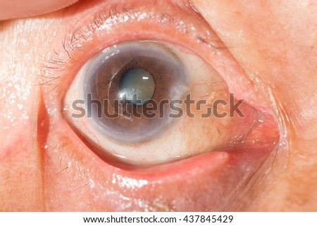 close up of the senile cataract during eye examination, senile cataract, mature cataract, neuclear sclerosis cataract.