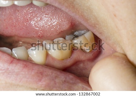 Tooth cavity