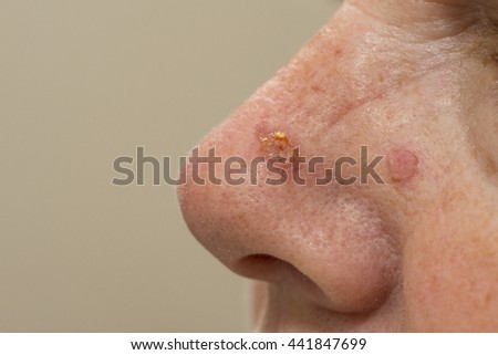 Sunspots on a nose that have been treated with cryosurgery