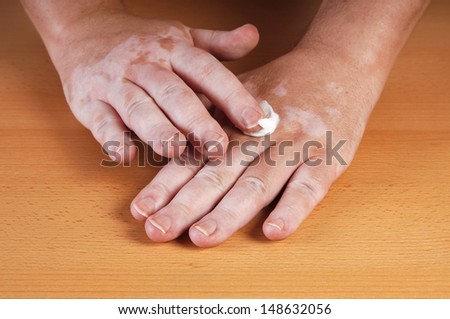 applying sunblocker or lotion to skin affected by vitiligo