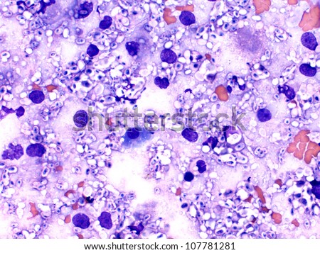 Cellular smear of cryptococcus fungi - lung and nasal cavity cytology showing fugal cryptococcus neoformans organisms with capsule