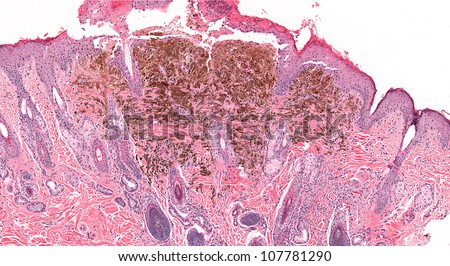 Melanoma of the skin with ulceration of the epidermal surface and expansion of the dermis by tumor cells containing melanin