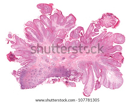 cutaneous papilloma