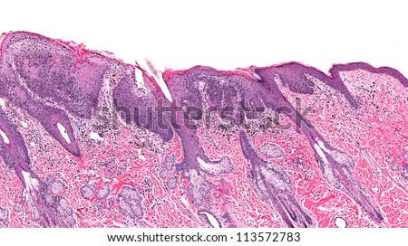Actinic keratosis and squamous cell carcinoma of skin showing squamous cell carcinoma (in situ) on the left and relatively normal skin on right side of image. Epidermis is thickened on left (cancer).