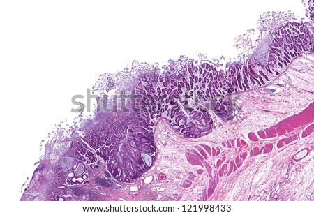Severe bacterial  (shigella, salmonella, cholera) infection of the intestines resulting in enteritis with ulcers of the intestinal mucosal lining and bacterial colonies adherent to the dead tissue.
