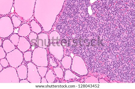 Normal healthy parathyroid gland (right half) embedded within and attached to the thyroid gland (left half). The thyroid gland is made of pink follicles containing thyroxine hormone.