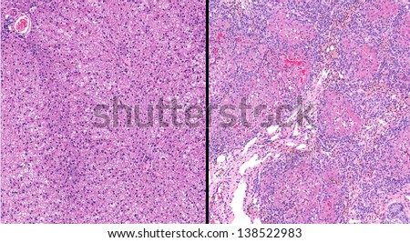 Normal healthy liver (left) compared to unhealthy diseased liver (right) with hepatic cirrhosis.