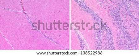 Normal healthy heart tissue (left) compared to heart muscle with metastatic lymphoma (right). The cardiac muscle is replaced by infiltrating neoplastic (tumor) cells that are stained blue.