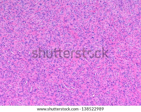 Nerve sheath tumor with slender spindle shaped tumor cells forming herring bone pattern with swirls of neoplastic cells and abundant collagen fibers.