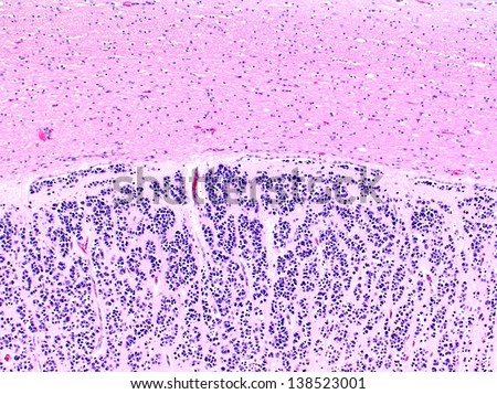 Ependymoma (bottom) a type of brain tumor arising from the ependymal cells in the ventricles and choroid plexus. The pink part on top is normal brain tissue invaded bu tumor cells.