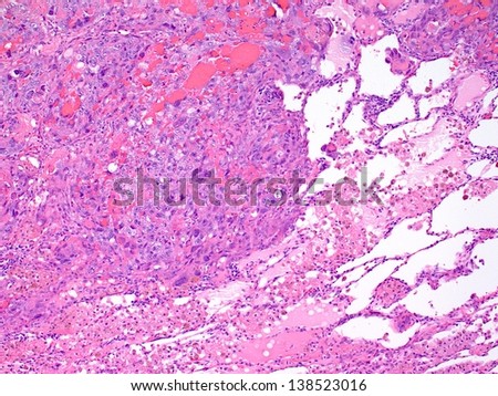 Squamous cell carcinoma of lung (left half of image) replacing normal healthy lung tissue (right side) with many tumor cell undergoing mitotic cell division
