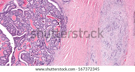 Colonic adenocarcinoma image with bone formation. The image shows intestinal epithelial cancer with osseous trabeculae and invasion of intestinal wall