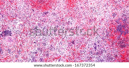 Myelofibrosis of the  bone marrow with replacement of normal marrow by fibrous connective tissue. There is loss of hematopoietic cells due to fibrosis of the bonemarrow.