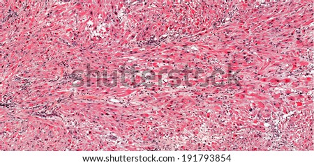 Malignant smooth muscle tumor leiomyosarcoma with bundles of cancer cells composed of smooth muscle fibers arranged in streaming bundles with mitosis