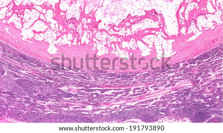 Metastatic colonic adenocarcinoma in the lymph node. Lymph node with metastasis of intestinal carcinoma (top half of image) with normal lymph tissue on the bottom. Mucinous intestinal cancer