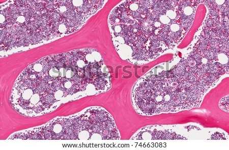 Normal healthy bone marrow depicting erythroid and myeloid cells