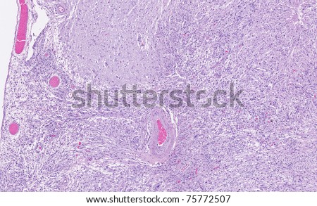 Microscopic image of meningioma (brain tumor) invading the brain. A small portion of normal brain tissue is visible on the upper right area.