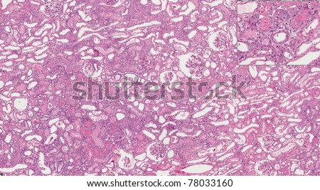 Kidney with tubular necrosis (tubular cell damage) with higher magnification in the inset.