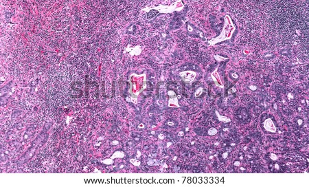 Lymph Node Metastasis