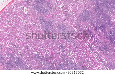 Inflammation of the renal interstitium. Kidney infection with clusters of inflammatory cells in the interstitial spaces.