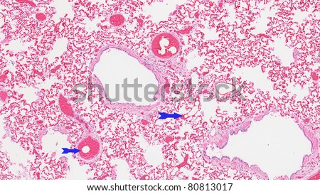 Fat embolism of the lungs.  Fat droplets (blue arrows) from the bone marrow that were dislodged and stcuk in the blood vessels of the lungs.