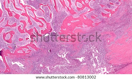 Osteomyelitis of the bone. Infection of the bone (osteomyelitis) resulting in separation and loss of boney spicules (pink ribbons) by inflammatory (infection) cells and scar tissue.