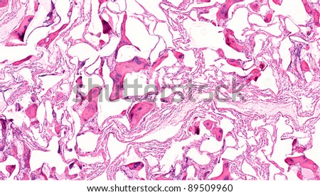 Pulmonary ossification.Bone formation in lung (ossification). Islands of bony tissue have replaced portions of normal lung alveoli. Ossifying pneumonitis.