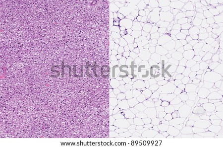 Normal healthy brown fat (left image) and normal healthy white fat. Brown adipose tissue or hibernating gland with small fat vacuoles (left) and white adipose tissue (right) with large fat vacuoles