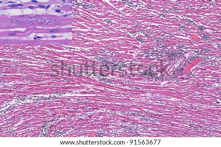 chagas myocarditis