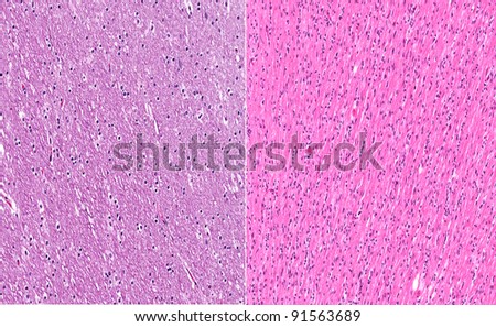 Normal healthy white matter of brain (left) in contrast to white matter of brain from a case of gliomatosis cerebri (right)