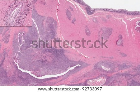 Endometriosis - Image illustrates uterine endometrium infiltrating the intestinal wall (blue islands of epithelium and stroma in the pink intestinal wall). Inset - magnified view of endometrial gland