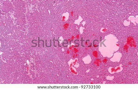 Hepatocellular carcinoma - Liver cancer (right half).  Liver tumor composed of irregular cords with blood filled cystic spaces. Poor demarcation between normal liver on left and cancer on right.