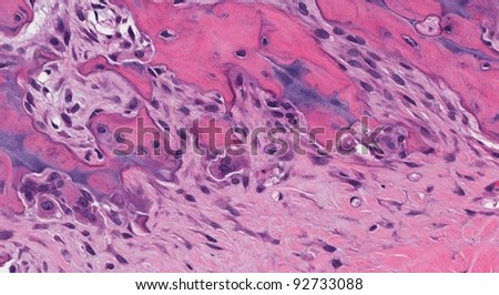 Osteoclasts (bone eating cells) lining scalloped edges of bone. Each osteoclast cell has multiple nuclei. See also osteoblasts.