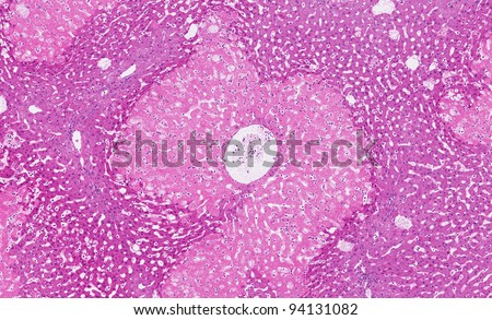 Acute necrosis (cell death) of the liver cells - the wide uniform band of pink cells are dead (necrotic) while the darker cells on the periphery are normal and healthy. Centrilobular hepatic necrosis