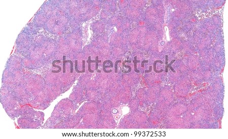 Cirrhotic liver with bands of scar tissue dissecting the liver with distortion of normal hepatic architecture. Cirrhosis of the liver